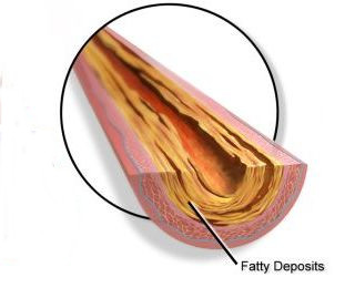 storage of fat in blood vessels